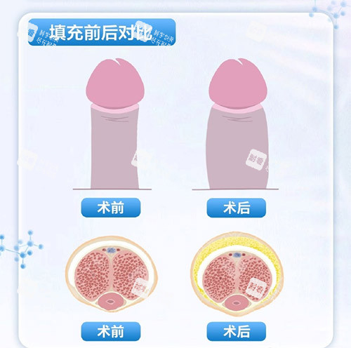 填充增大增粗示意图