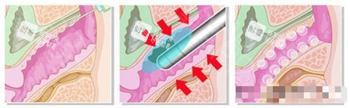 菲蜜丽过程卡通图 菲蜜丽过程卡通图