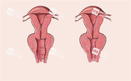 女性阴道松弛和紧致对比 女性阴道松弛和紧致对比