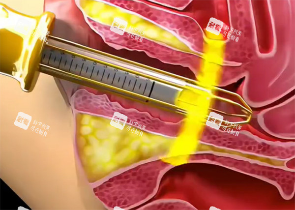 紧缩针紧缩推药照片 紧缩针紧缩推药照片