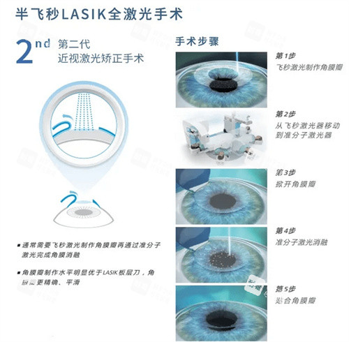半飞秒手术示意图