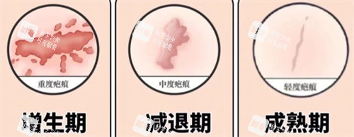 开眼角术后疤痕期