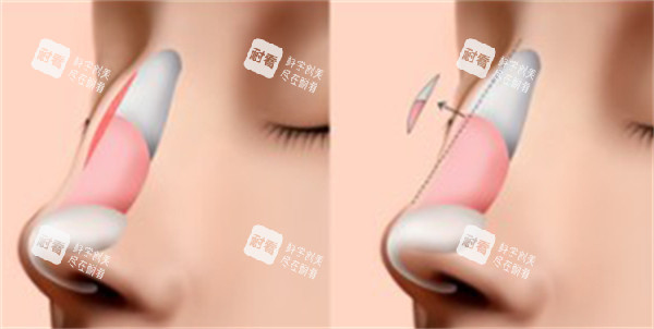 韩国隆鼻前后图片