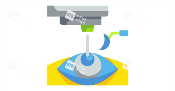 近视眼手术图 近视眼手术图