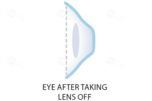 取下角膜塑形镜后 取下角膜塑形镜后