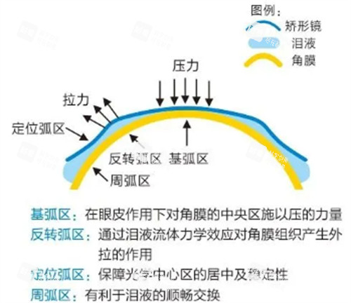 角膜塑形镜功效图示 角膜塑形镜功效图示