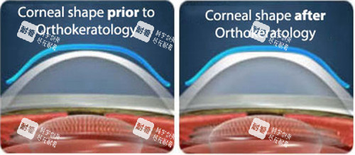 角膜塑形镜眼表前后对比