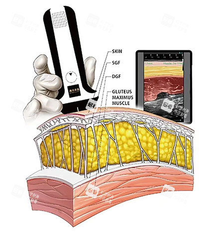 维密金雕原理示意图