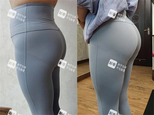 臀部吸脂手术侧面对比图 臀部吸脂手术侧面对比图