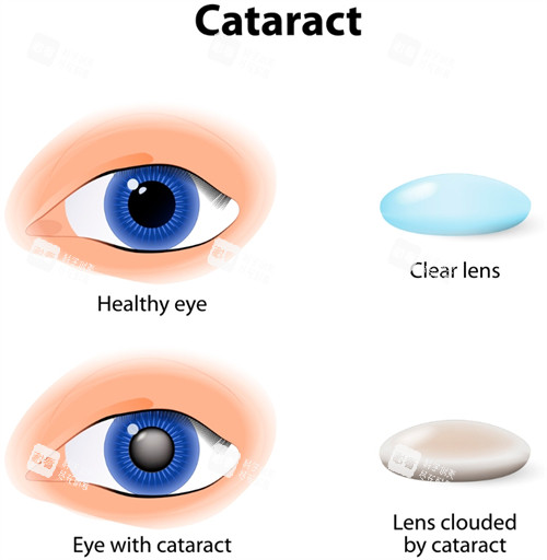 白内障眼睛和正常眼睛区别 白内障眼睛和正常眼睛区别