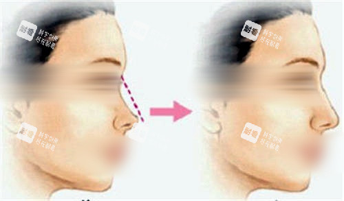 鼻背隆鼻填充前后对比图