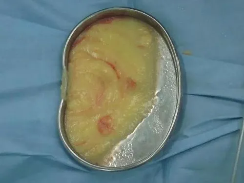 取出的奥美定实拍示意图 取出的奥美定实拍示意图