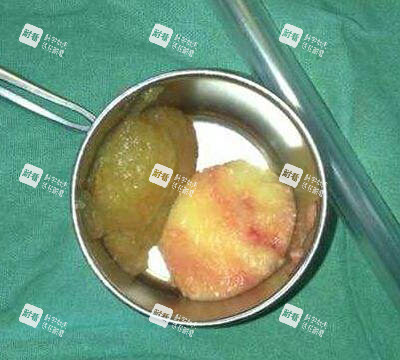 取出的奥美定照片 取出的奥美定照片