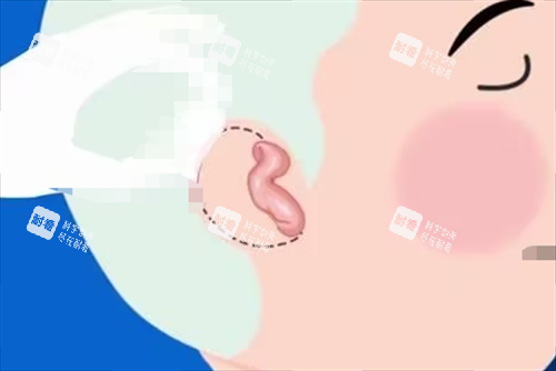 儿童耳再造耳畸形展示