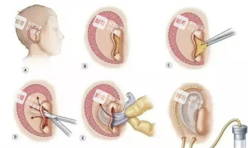 耳再造皮肤扩张