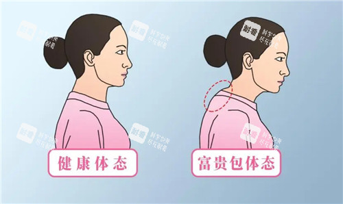 有无富贵包对比