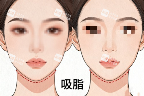 下巴做吸脂前后对比图