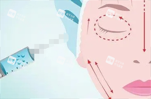玻尿酸面部填充示意图