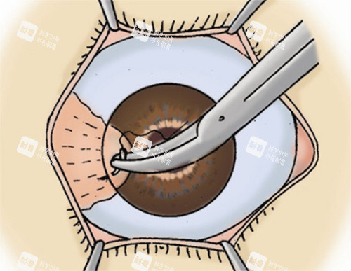 角膜移植手术缝合过程图解 角膜移植手术缝合过程图解