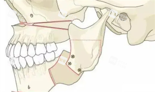 正颌手术后的形状 正颌手术后的形状