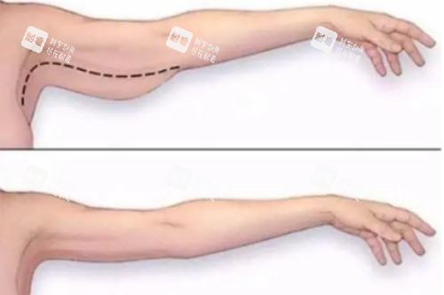 拜拜肉吸脂对比图 拜拜肉吸脂对比图