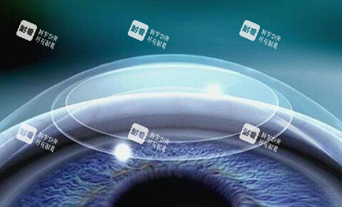 激光近视改善展示照片 激光近视改善展示照片