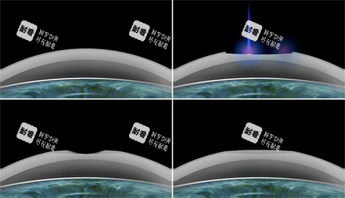 smart激光近视手术过程 smart激光近视手术过程