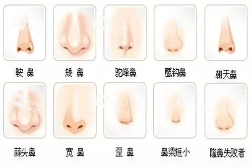 不美观鼻型示意图