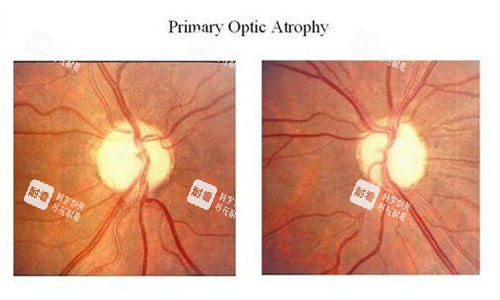 视神经萎缩的眼底
