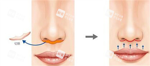 人中缩短改善卡通图展示 人中缩短改善卡通图展示