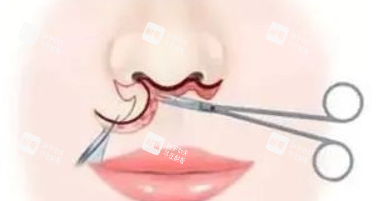 埋线人中缩短术手术过程图解 埋线人中缩短术手术过程图解