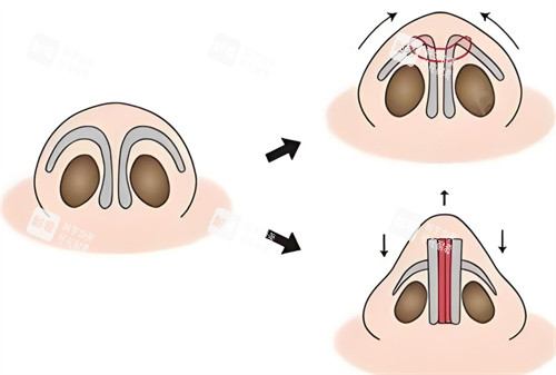 鼻头缩小原理 鼻头缩小原理