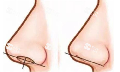 鼻头缩小对比 鼻头缩小对比