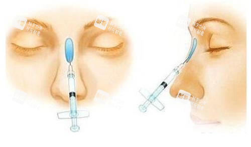 液态隆鼻示意图 液态隆鼻示意图