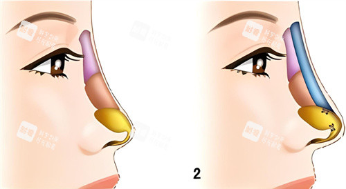隆鼻假体对比图示 隆鼻假体对比图示