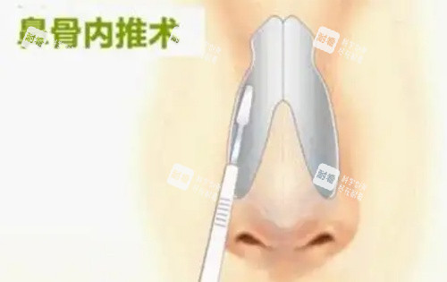 鼻骨内推示意图