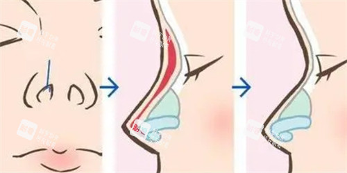 隆鼻手术过程 隆鼻手术过程