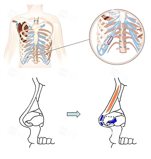全肋骨隆鼻术手术展示动画图 全肋骨隆鼻术手术展示动画图