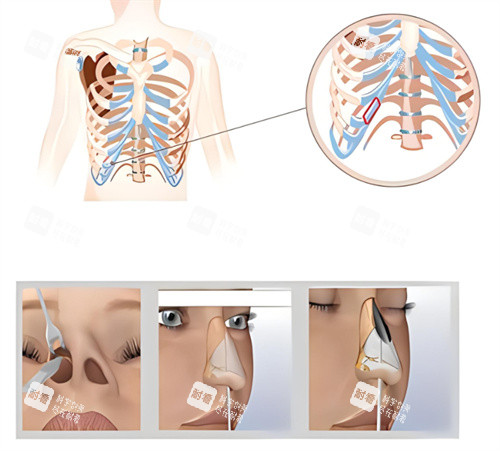 隆鼻肋骨鼻原理图 隆鼻肋骨鼻原理图