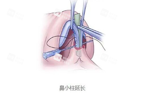 鼻小柱延长改善图