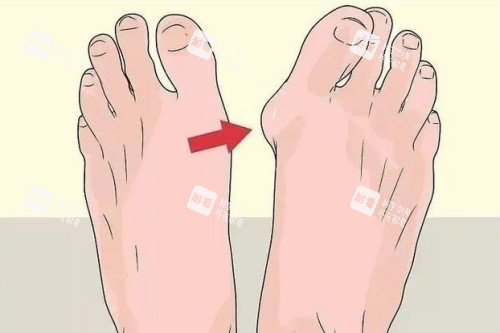 大脚骨整形前后对比图