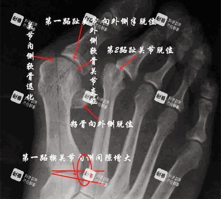 大脚骨X光片