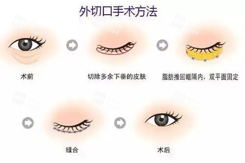 眼袋整形卡通示意图 眼袋整形卡通示意图