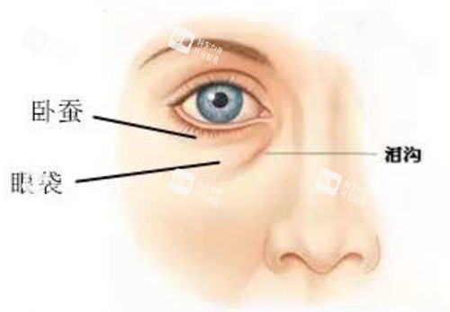 眼下卧蚕泪沟及眼袋对比示意图 眼下卧蚕泪沟及眼袋对比示意图
