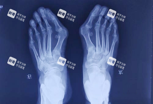 大脚骨拍片