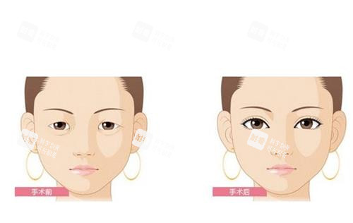 开眼角前后效果图