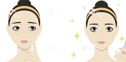 激光祛斑对比示图