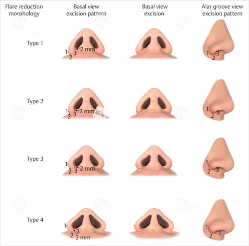 不同鼻子缩小鼻翼对比图