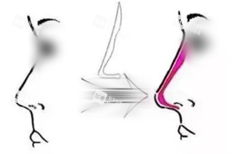 隆鼻手术填充前后对比图 隆鼻手术填充前后对比图