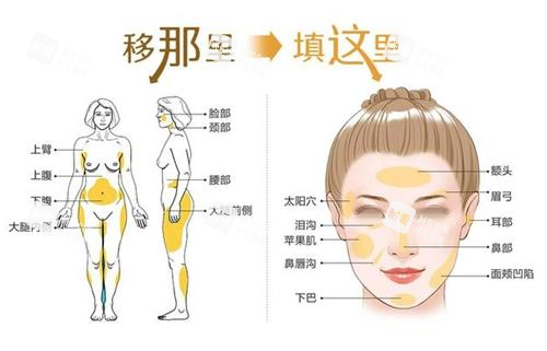 自体脂肪面部填充步骤图